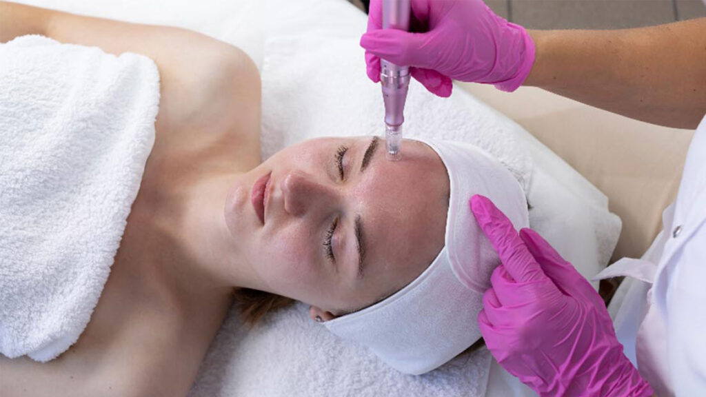 Microneedling-&-Chemical-Peel-Level-4