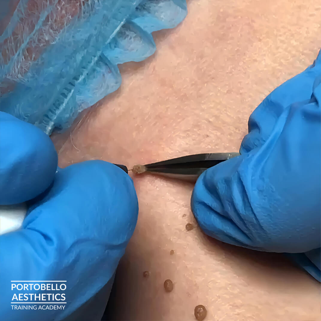 Skin blemish removal advanced epilation training